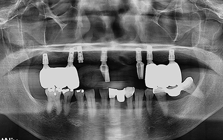 임플란트 사례9