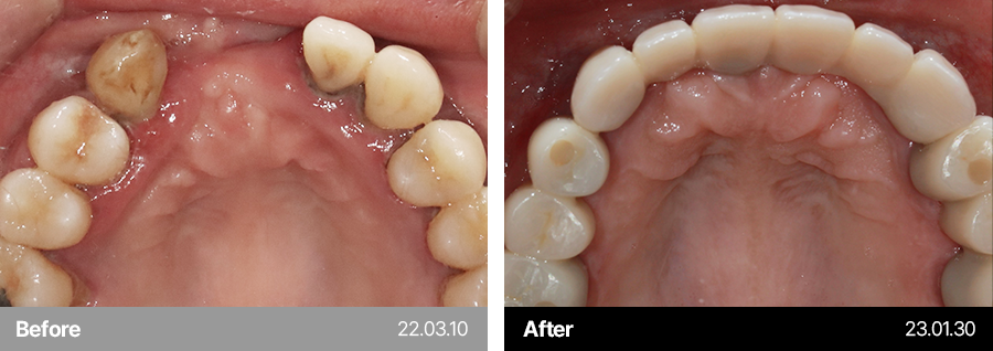 임플란트 사례1