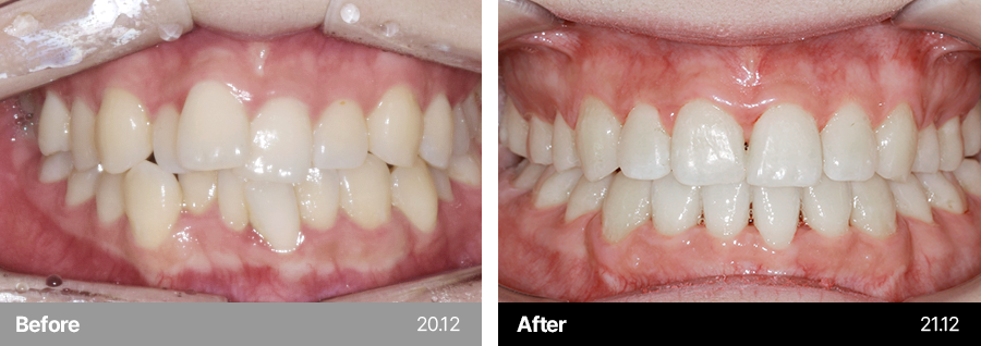 치아교정 사례1
