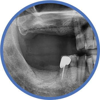 뼈이식 시술 후 X-ray