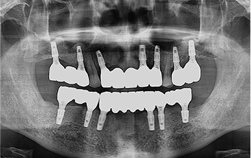 임플란트 후 X-ray 2022-08-04