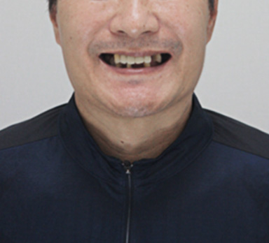 전체임플란트 전