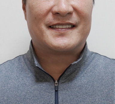 전체임플란트 후
