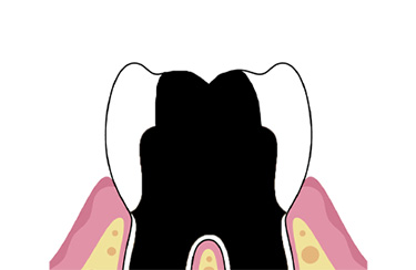 충치 4단계 - 치아 전체가 손상된 상태